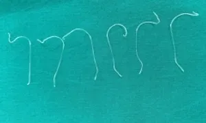 Biến chứng sau nâng mũi bằng chỉ Biến chứng sau nâng mũi bằng chỉ