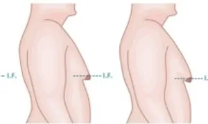 Vì sao nam giới có hiện tượng ngực to như phụ nữ? Vì sao nam giới có hiện tượng ngực to như phụ nữ?