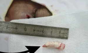 Cựa gà trống 2,8 cm đâm sâu vào mặt người đàn ông Cựa gà trống 2,8 cm đâm sâu vào mặt người đàn ông